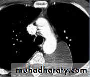 Mediastinum