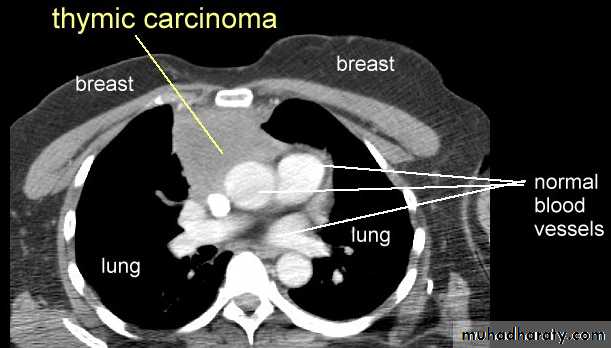 Mediastinum