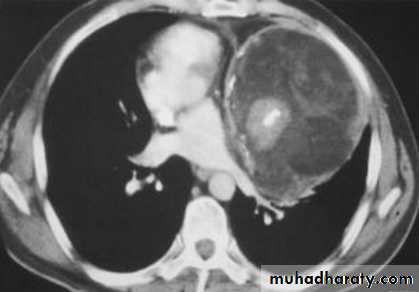 Mediastinum