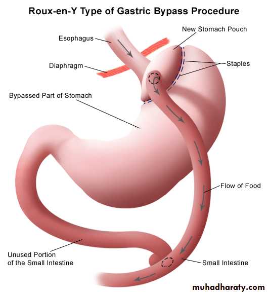 Surgical RX for Obesity
