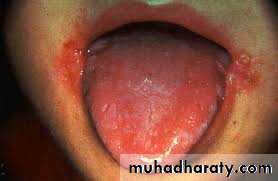 Malabsorption of Fat-Soluble Vitamins