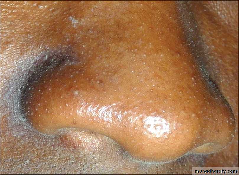 Malabsorption of Fat-Soluble Vitamins