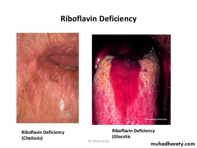 Malabsorption of Fat-Soluble Vitamins