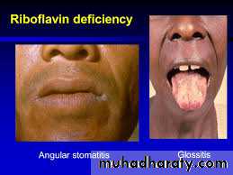 Malabsorption of Fat-Soluble Vitamins