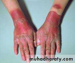 Malabsorption of Fat-Soluble Vitamins