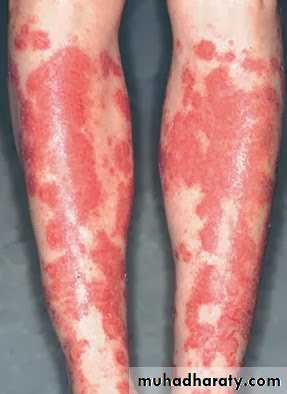 Malabsorption of Fat-Soluble Vitamins