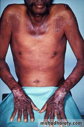 Malabsorption of Fat-Soluble Vitamins