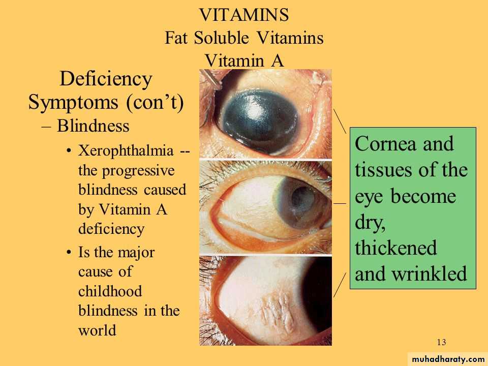 Malabsorption of Fat-Soluble Vitamins