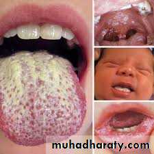 Yeast infection