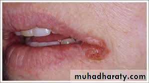 Yeast infection