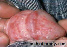 Yeast infection