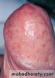 Yeast infection