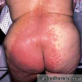 Yeast infection