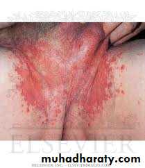 Yeast infection