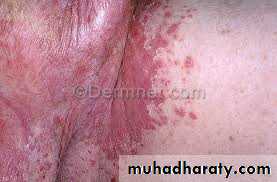 Yeast infection