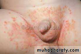 Yeast infection