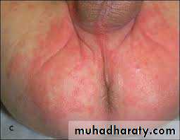 Yeast infection