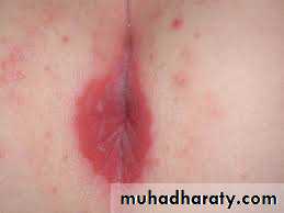 Yeast infection