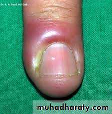 Yeast infection