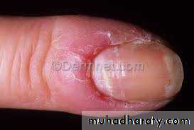 Yeast infection