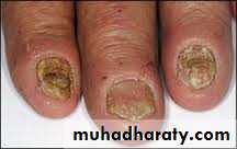 Yeast infection