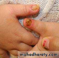 Yeast infection