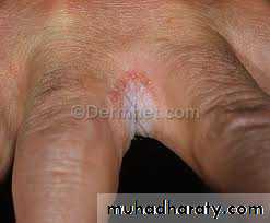 Yeast infection