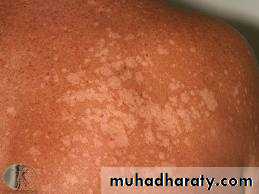 Yeast infection