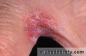 Yeast infection