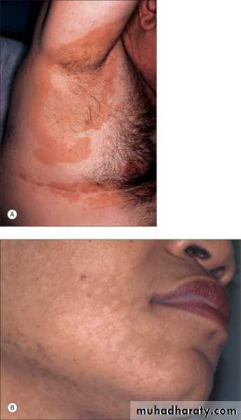 Yeast infection