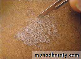 Yeast infection