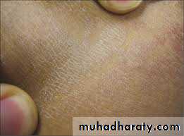 Yeast infection