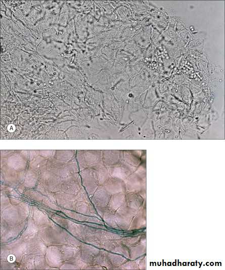 Yeast infection