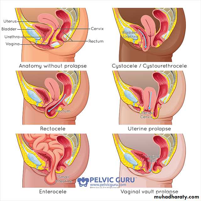 Pelvic organ prolapse