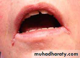 Nutritional Deficiency