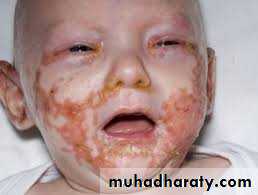 Nutritional Deficiency