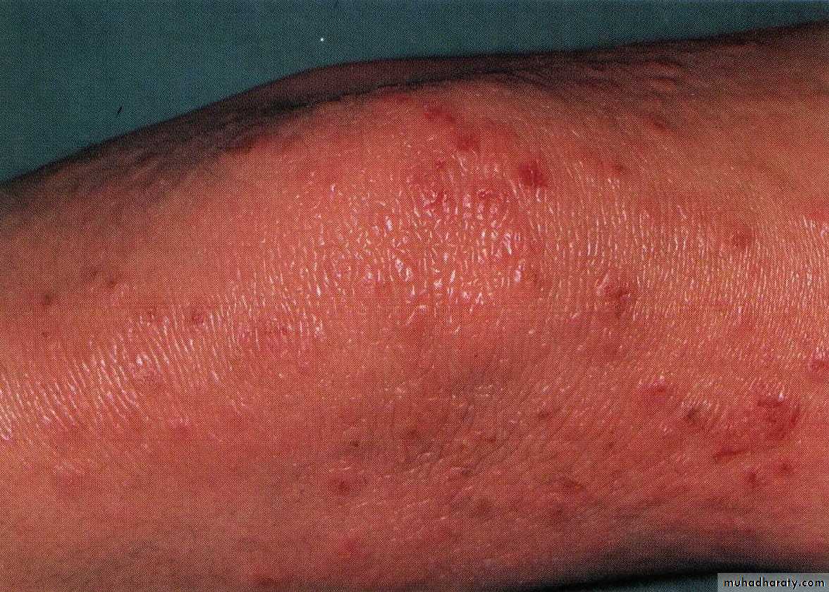 Overview of Viral Infections
