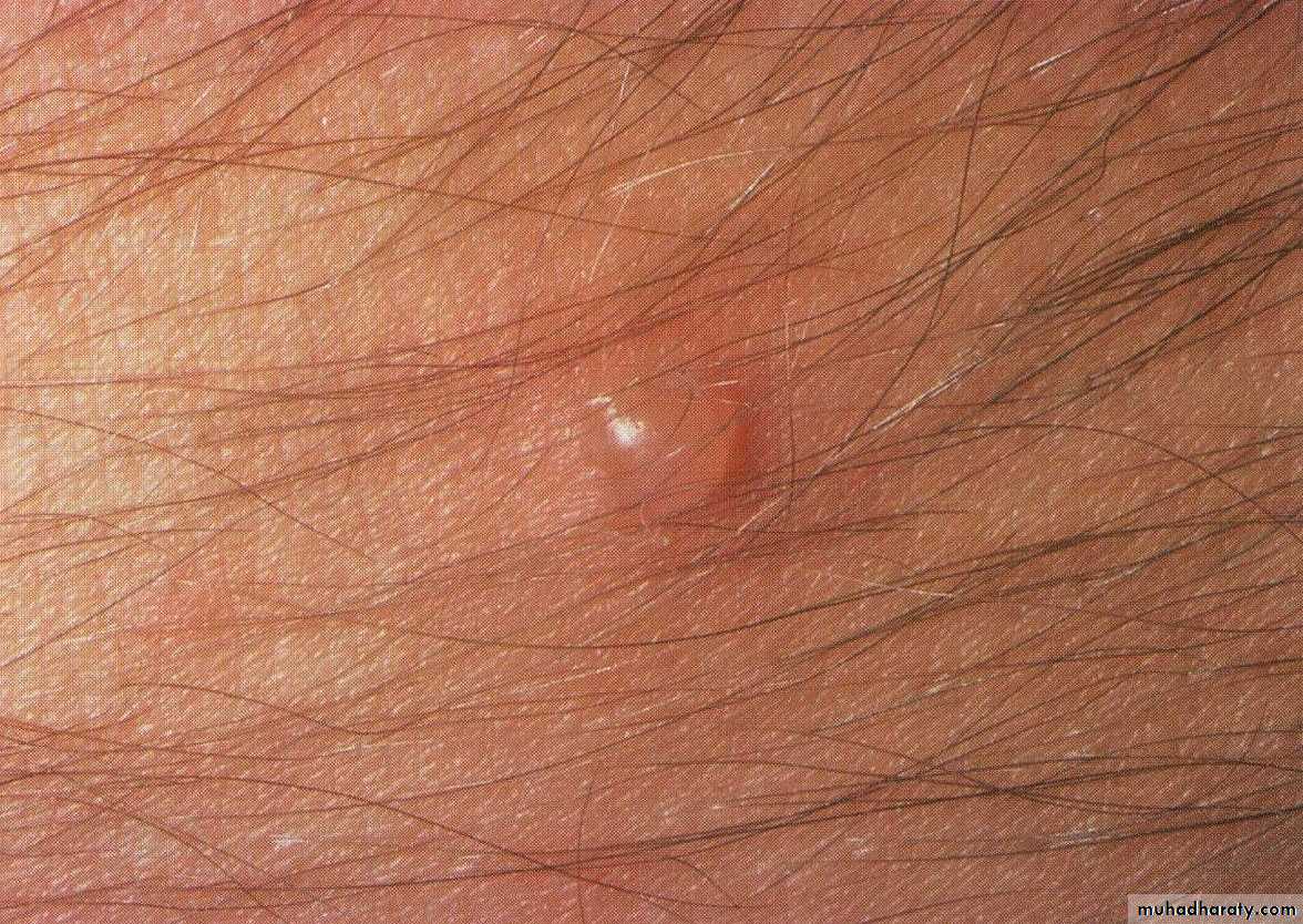 Overview of Viral Infections