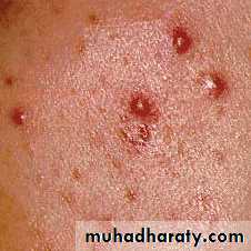 Overview of Viral Infections