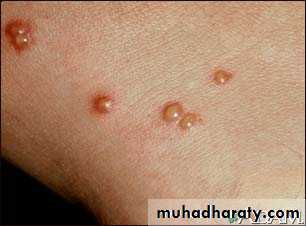 Overview of Viral Infections