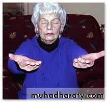 Hypertension and Stroke