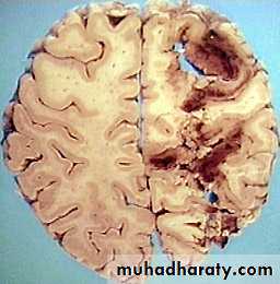 Hypertension and Stroke