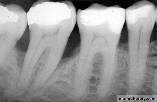 INTERPRETATION OF ENDODONTIC RADIOGRAPH