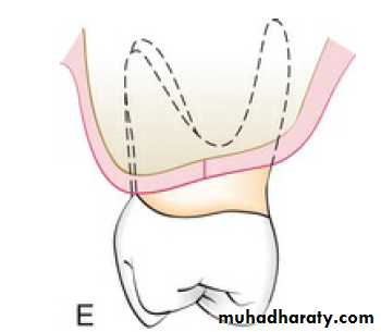 flap surgery