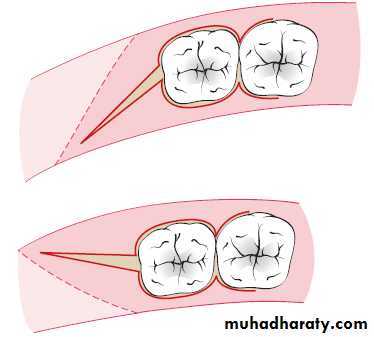 flap surgery
