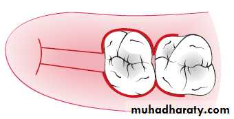 flap surgery