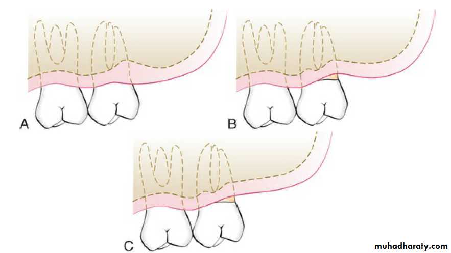 flap surgery