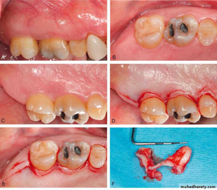 flap surgery