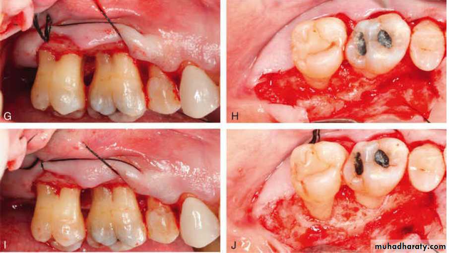 flap surgery