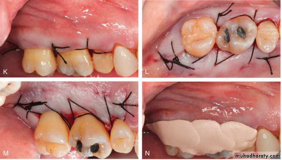 flap surgery